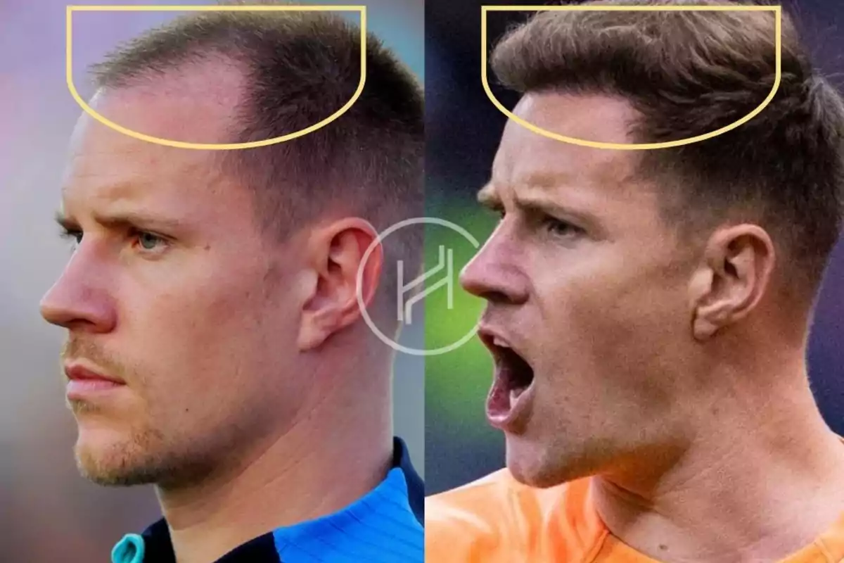 Comparison of the same man before and after a hair transplant, showing a noticeable difference in hair density at the front of the head. Comparison of the same man before and after a hair transplant, showing a noticeable difference in hair density at the front of the head.
